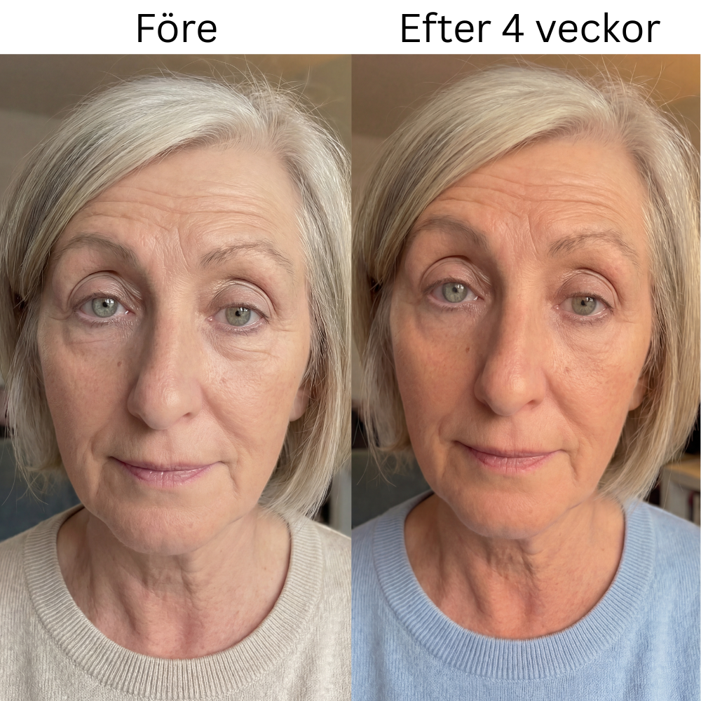 Micro-Infusion Patches